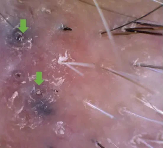 45일 전 시술경과이미지