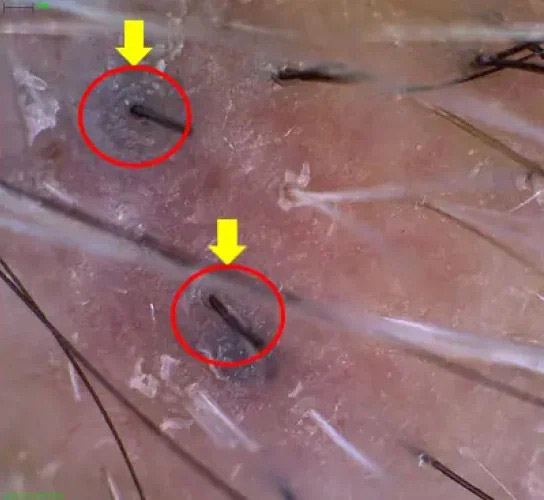 45일 후 시술경과이미지