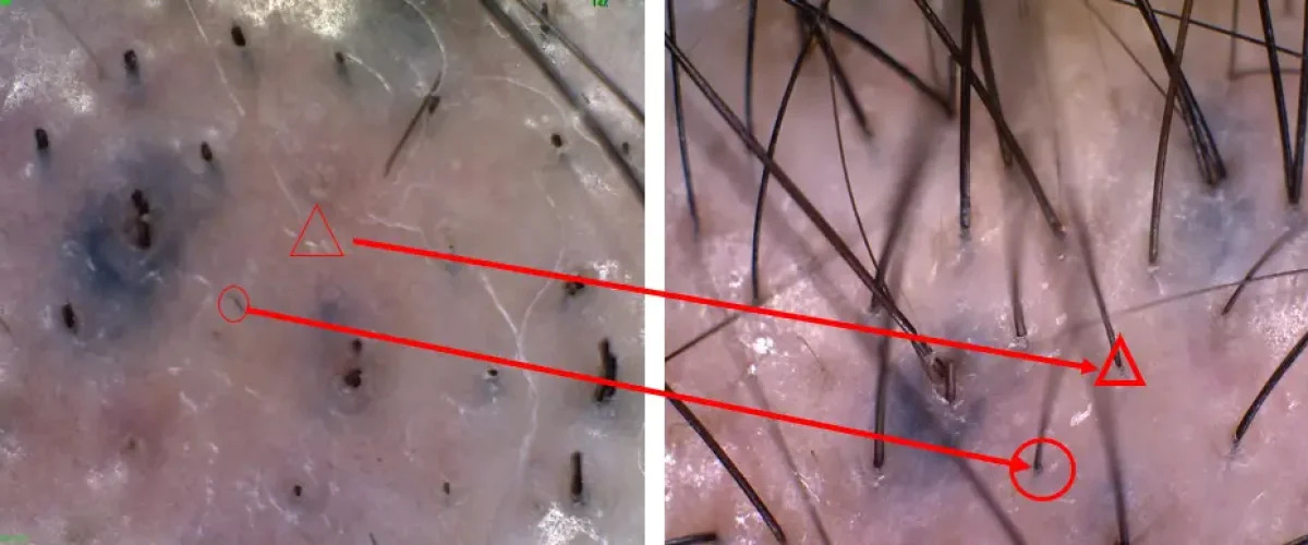 180일 전 시술경과이미지