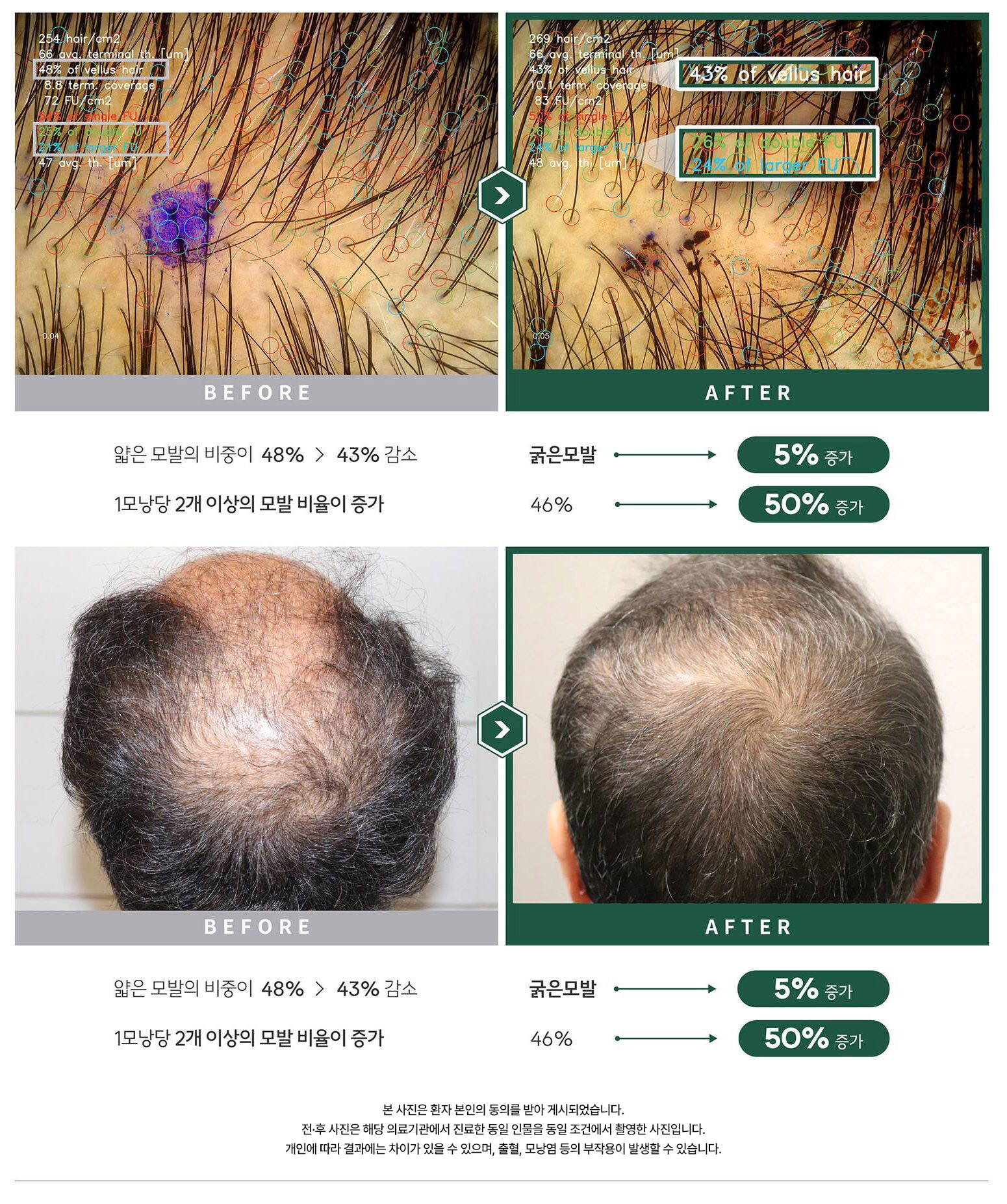 자가모근줄기세포 사진