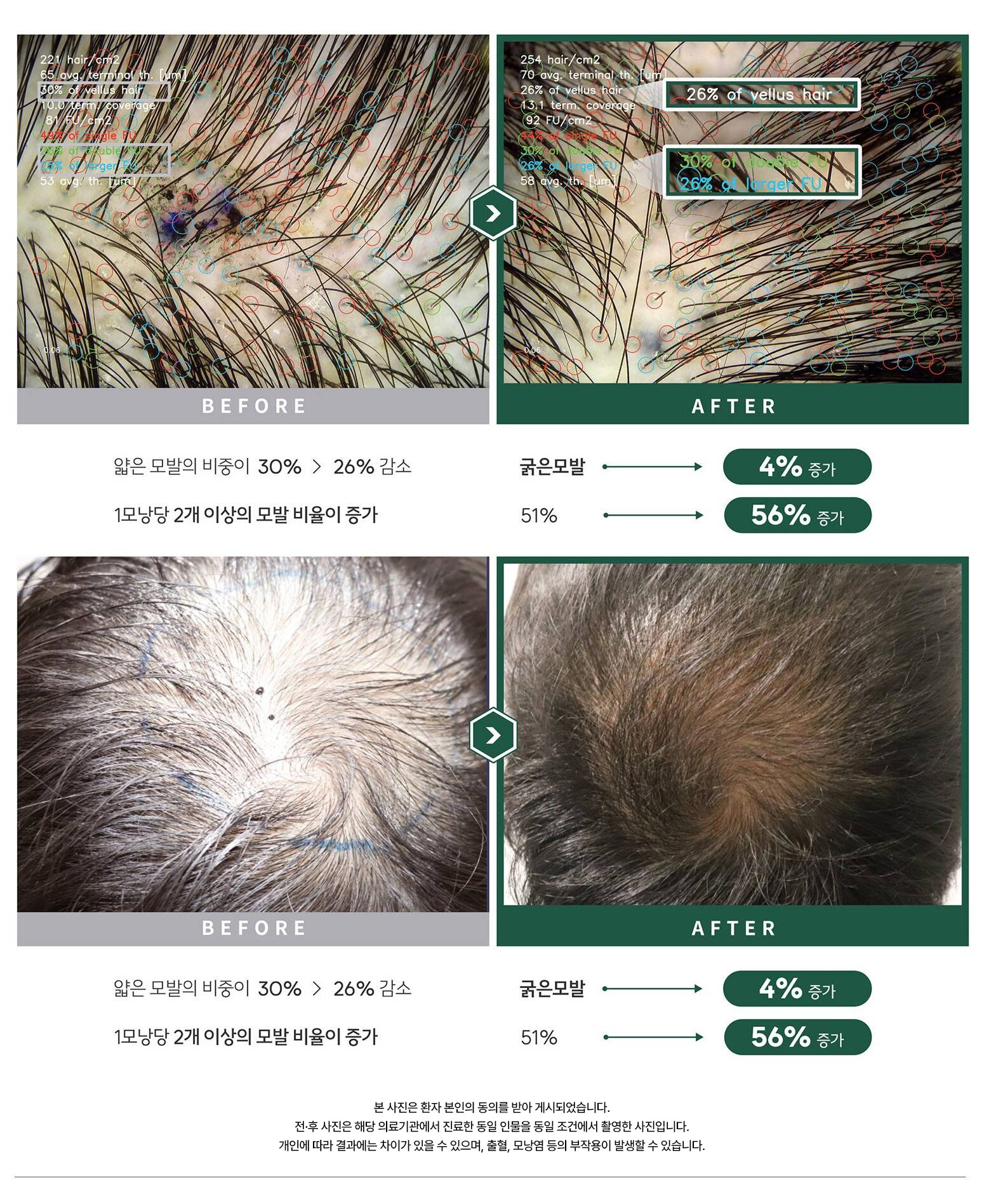 자가모근줄기세포 사진