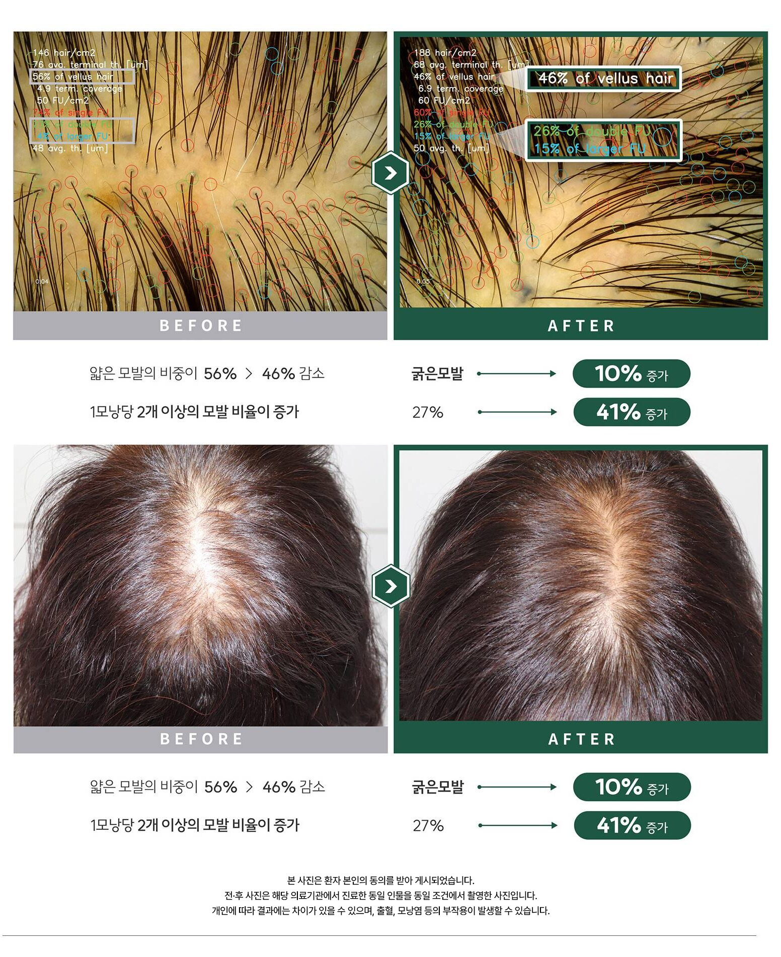 자가모근줄기세포 사진