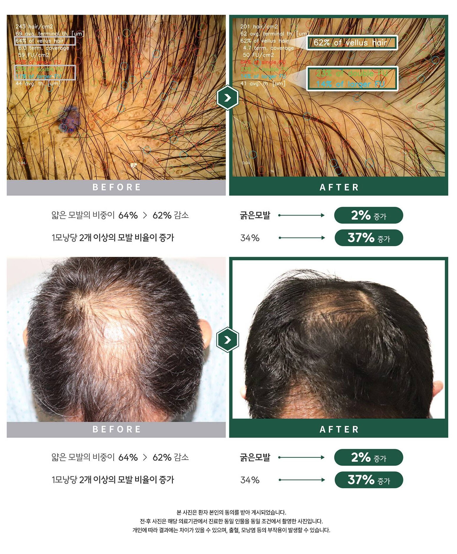 자가모근줄기세포 사진