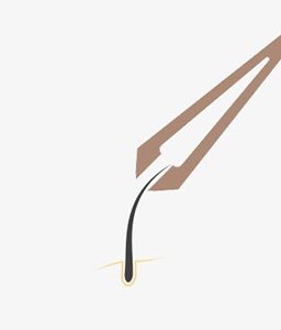 포셉으로 모낭을 뽑아내는 이미지