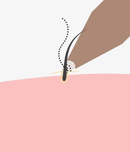 모낭을 이식할 부위에 이식하는 이미지